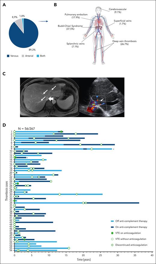 Features of Budd-Chiari syndrome in PNH. (A) A pie chart illustrates the type of TEs. (B) A cartoon showcases the anatomic site of origin of thromboses. (C) Left panel shows magnetic resonance imaging (MRI) of a 59-year-old man, whereby on the axial postcontrast VIBE (volumetric interpolated breath-hold examination), the hepatic veins are decreased in caliber (thin arrows) and demonstrate peripheral pruning, however there is no residual hepatic venous filling defect to suggest thrombus. The intrahepatic inferior vena cava (IVC; thick arrow) is significantly narrowed without IVC thrombosis. On the right, a Doppler ultrasound image of the IVC of an 89-year-old male shows the hypoechoic and nonocclusive thrombus in the lumen (arrow). (D) A swimmer plot illustrates the longitudinal follow-up, and anticomplement and anticoagulation strategies in patients experiencing TEs in our cohort. ∗Patients for whom precise dates on subsequent thrombotic events (5 episodes for UPN 9 and 3 episodes for UPN 13) are lacking.