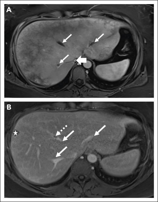 Radiologic features of thrombosis at diagnosis and follow-up of a 45-year-old woman with PNH. (A) Axial postcontrast VIBE MRI of a 45-year-old woman demonstrates heterogeneous enhancement of the liver. There is bland thrombus in 3 hepatic veins (thin arrows) and decreased IVC caliber without discrete thrombus (thick arrow). (B) After treatment, axial postcontrast VIBE image demonstrates significantly decreased thrombus burden from the prior (thin arrows) with persistent thrombus within middle hepatic vein (dashed arrow). The star indicates an incidental cyst in the liver periphery.