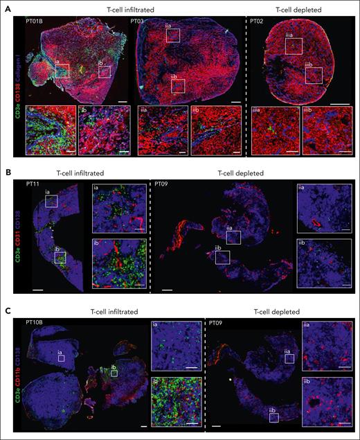 T-cell infiltration of EMD lesions. Representative IF of T-cell–infiltrated and T-cell–depleted EMDs. (A) IF of PT01B (left), PT03 (center), and PT02 (right) for markers of T cells (α-CD3e, green), PCs (α-CD138, red), and collagen (α-Collagen I, blue). (B) IF of PT11 (left) and PT09 (right) for markers of T cells (α-CD3e, green), PCs (α-CD138, blue), and endothelium (α-CD31, red). (C) IF of PT10B (left) and PT09 (right) for markers of T cells (α-CD3e, green), PCs (α-CD138, blue), and myeloid cells (α-CD11b, red). Scale bars 500 μm. Inlay scale bars 100 μm.