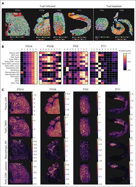 Focal infiltration of immune cells in EMD lesions. (A) Clusters generated using the Leiden algorithm based on estimated cell type abundances calculated from cell type deconvolution using cell2location of ST data of samples taken from PT01A, PT01B, PT03, and PT11 for T-cell–infiltrated lesions and PT02 and PT09 for T-cell depleted lesions. (B) Heat map showing the scaled z score of estimated cell abundance of cell types across Leiden clusters shown in panel A for T-cell–infiltrated lesions (PT01A, PT01B, PT03, and PT11). (C) Estimated spatial cell type abundances of PCs, T-cells Tim3+, M1 macrophages, and CD8+ cytotoxic T cells across samples, as in panel B.