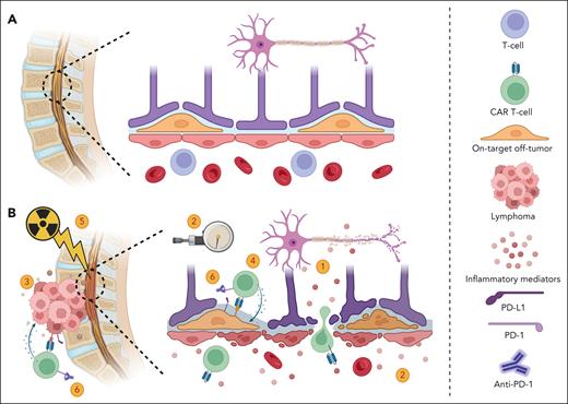 Potential mechanisms of acute myelopathy following CAR T cells. (A) Normal spinal cord and BBB. (B) Acute myelopathy after infusion of CAR T cells. Several potential mechanisms are likely involved and may interact, including: (1) inflammatory mediators disrupt the BBB and exert direct toxicity; (2) a decrease in blood flow to the spinal cord that can potentially lead to infarction can be caused by elevated intraspinal canal pressure secondary to inflammation; (3) local inflammation from an adjacent tumor causes BBB damage and neuronal cell injury (TIAN); (4) on-target off-tumor toxicity of CAR T cells. Potential targets include CD19-expressing mural cells (illustrated), which can lead to BBB disruption, and CD22-expressing oligodendrocytes, which can cause demyelination; and (5) radiation therapy damages the BBB and/or sensitizes neuronal cells to neurotoxicity; and (6) ICIs may enhance on-target off-tumor toxicities or promote increased secretion of inflammatory mediators when CAR T cells are activated at the tumor site. Other contributing factors may include tumor histology, patient sex, and age. Figure created with BioRender.com.