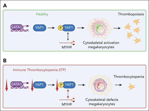 The role of YAP in ITP. In a healthy setting (A), YAP1 expression is upregulated through binding of GATA1 to its promoter in MKs. Phosphorylated YAP1, through its interaction with MYH9, promotes MK-cytoskeletal activation, which enables thrombopoiesis. In ITP (B), GATA1 and YAP1 expression is decreased, which impairs the interaction between phosphorylated YAP1 and MYH9, resulting in MK-cytoskeletal defects with subsequent development of thrombocytopenia. Figure created with BioRender.com.