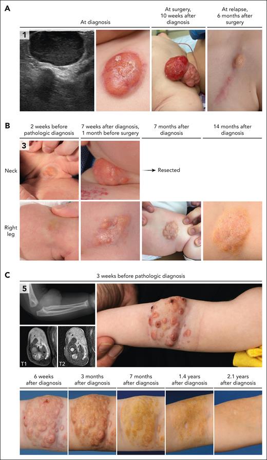 Clinical and radiologic features of patients with CSF1R mutations. (A) Ultrasound and clinical images of the lesion of case 1. This infant was noted to have a small red/purple lesion on the chest at birth. The lesion increased in size over time and developed a central crust. Ultrasound revealed a well-demarcated, homogeneous, hypoechoic lesion with rich vascularization. A biopsy was taken 7 weeks after birth, leading to a diagnosis of JXG. The lesion continued to grow rapidly, with recurrent ulceration and occasional bleeding, before it was resected at 10 weeks after diagnosis. A small recurrence was observed in the scar at 6 months after surgery; this lesion was left untreated and slowly regressed over the following 2 years. (B) Clinical images of the multifocal lesions in case 3. Both lesions were present at birth and progressed over time. A biopsy was taken of the right upper leg lesion 8 weeks after birth and revealed JXG. In the following weeks, the right sided neck lesion grew significantly, and the infant developed a head turning preference for the left side. Therefore, it was decided to resect the neck tumor. The right upper leg lesion continued to grow for several months but eventually regressed spontaneously. (C) Radiologic and clinical images of the tumor in case 5. This infant was noted to have 2 small lesions on the proximal right lower arm at birth. In the following months, a large tumor developed in the lower arm, with a remarkable nodular aspect. Conventional radiography demonstrated intact osseous structures. Magnetic resonance imaging (MRI) at 4 months after birth revealed a 2.8 × 1.6 × 4.2 cm large soft tissue tumor, extending inward between the flexor digitorum superficialis and profundus. A biopsy was taken, leading to a diagnosis of JXG. The patient was managed by active monitoring and experienced spontaneous regression of the tumor. T1, longitudinal relaxation time; T2, transverse relaxation time.
