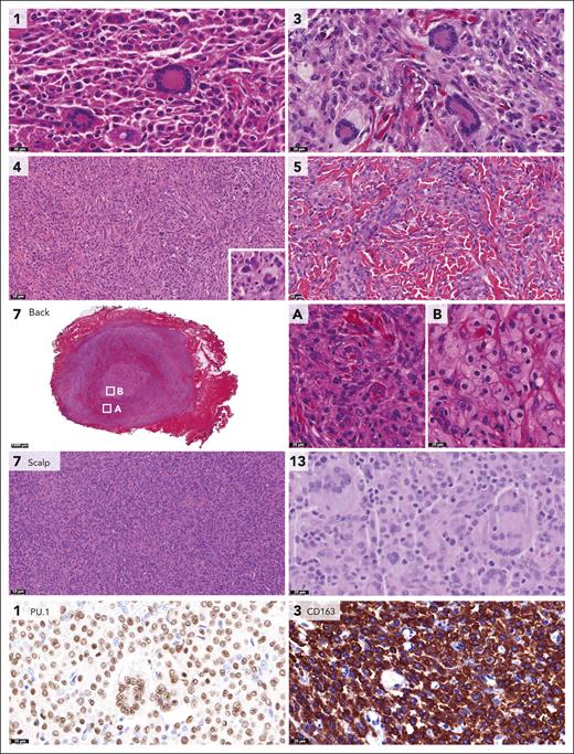 Pathologic features of histiocytic neoplasms with CSF1R mutations. Photomicrographs of hematoxylin and eosin (H&E)–, PU.1-, or CD163-stained slides. Numbers indicate cases. Shown are the histiocytic lesions with multiple Touton giant cells in cases 1 and 3, the storiform-like histologic pattern in case 4 (with a multinucleated cell in the inlet), and the monomorphic histiocytic infiltrate dissecting through the dermal collagen bundles in case 5. In addition, the intramuscular tumor of case 7 is depicted, which was located on the back and contained large collections of foamy histiocytes. In contrast, the scalp lesion of case 7 consisted of a dense monomorphic infiltrate without lipidized histiocytes. Finally, the endotracheal tumor of case 13 was characterized by multiple Touton and Touton-like giant cells (the latter have no or limited foamy cytoplasm), in addition to many mononucleated histiocytes with predominantly round to ovoid nuclei. Histiocytes stained positive for PU.1 and CD163, as illustrated by photomicrographs of the tumors of cases 1 and 3. Histology of the abdominal tumor of case 6 with a CSF1R deletion and an MRC1::PDGFRB fusion is provided in supplemental Figure 1.