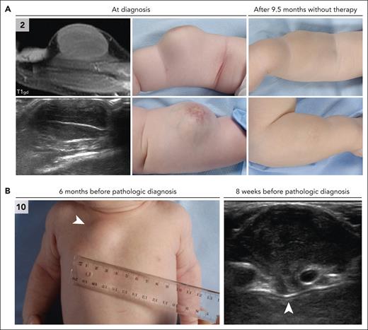 Clinical and radiologic features of patients with CLTC::SYK fusions. (A) Radiologic and clinical images of the tumor in case 2. The tumor of the right lower arm was present at birth and had rapidly increased in size over time. On physical examination, the tumor was firm, adherent to the underlying musculature, and separate from the skin. The overlying skin exhibited telangiectatic changes, possibly because of fast growth of the tumor. Ultrasound revealed a well-demarcated, hypoechoic, vascularized lesion. MRI demonstrated that the tumor was closely related to the underlying extensor carpi radialis brevis muscle. A biopsy was taken 2 months after birth and a diagnosis of JXG was made. The patient was managed by active monitoring and the tumor gradually decreased in size and consistency. At a follow-up visit 1.6 years after diagnosis, the tumor was no longer recognizable. (B) Clinical and ultrasound images of the tumor in case 10. This infant presented 4 weeks after birth with a thoracal mass that had been noted by the parents for 1 day. On physical examination, the mass was firm-elastic, nontender, adherent to the underlying tissue, and separate from the skin. The patient had no other symptoms; therefore, a diagnosis of self-limiting sternal tumor of childhood37 was assumed, and the patient was managed by active monitoring. Follow-up ultrasound evaluations revealed slow progression of the parasternal lesion, which extended between the second and third ribs to the parietal pleura. Therefore, subtotal surgical resection was eventually performed at 6.5 months after presentation; pathological analysis resulted in a diagnosis of JXG. At 2 months after surgery, the parasternal lesion was not detectable using ultrasound and the child was in clinical remission.