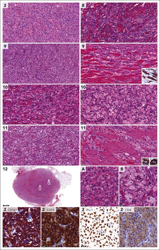 Pathologic features of histiocytic neoplasms with CLTC::SYK fusions. Photomicrographs of H&E-, CD163-, CD14-, PU.1-, or CD4-stained slides. Numbers indicate cases. Depicted are the dense histiocytic lesion with interspersed eosinophilic granulocytes in case 2, and histiocytic cells in between hyalinized collagen in case 8. In addition, the storiform-like histologic patterns in cases 9 and 11 are shown, as well as the histiocytes dissecting through the musculature that were observed in these cases. The inlets demonstrate that the cells stained positive for CD163 and had variable nuclear contours. The images of cases 10 and 12 depict dense populations of cells with xanthomatized eosinophilic cytoplasm, as well as collections of foamy histiocytes. As illustrated by photomicrographs of the tumor of case 2, histiocytes stained positive for CD163, CD14, and PU.1, whereas CD4 was more weakly positive.