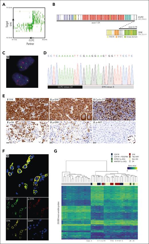 Multimodal detection and characterization of CLTC::SYK fusions. (A) Exemplary butterfly plot of TLC-NGS data, uncovering the CLTC::SYK fusion in case 12. Proximity ligation products between the target gene (SYK) and rearrangement partner (CLTC) are depicted in green. The shade of green indicates the coverage. Strand directions are indicated by arrows. Details of TLC-NGS methodology are available in a prior publication by Allahyar et al.22 (B) Illustration of the CLTC::SYK fusion, which leads to a transcript joining CLTC exon 31 to SYK exon 6, as demonstrated by RNA sequencing. (C) Photomicrograph showing separation of red and green signals in lesional cells of the tumor of case 10 using SYK break-apart FISH. The green signal represents the FITC-labeled probes (which bind proximal of SYK), whereas the red signal represents the Cy3-labeled probes (which bind distal of SYK). (D) Sanger sequence demonstrating the fusion of CLTC intron 31 to SYK intron 5 in case 9. Sanger sequencing results for all patients with CLTC::SYK fusions are depicted in supplemental Figure 3. (E) Exemplary photomicrographs of the tumor of case 2, demonstrating expression of SYK, p-SYK, cyclin D1, and p-S6 (a marker of mTOR activation). In addition, rare p-ERK+ cells can be observed, whereas tumor cells were negative for p-Akt despite adequate positive external controls (endometrial cancer with PIK3CAH1047R mutation; SignalSlide Akt Family IHC Control from Cell Signaling). The SignalSlide Akt Family IHC Control is shown in the inlet. P-ERK expression of all tumors with CLTC::SYK fusions is depicted in supplemental Figure 2. (F) Exemplary multispectral immunofluorescence image of the tumor of case 12, demonstrating SYK and p-SYK expression by CD163+ histiocytes. (G) Unsupervised hierarchical clustering of 29 XG family lesions and 18 common or atypical dermatofibromas (DF; included as controls) using the methylation data of the 20 000 most variable probes. In the heat map, columns represent samples, and rows represent probes. The level of DNA methylation is indicated by beta values and depicted using a color scale. A beta value of 1 corresponds to a fully methylated CpG site; a value of 0 to an unmethylated site. Above the heat map, the clinical and/or molecular subgroup is shown for each sample; below the heat map, case numbers of patients described in this study are depicted. FITC, fluorescein isothiocyanate; IHC, immunohistochemistry. Panel B illustration made with the St Jude ProteinPaint web application.