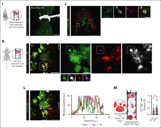 Procoagulant platelet activation is a hallmark of venous thrombosis in human individuals and mice. (A) Scheme of clinical cohort and performed imaging entities to confirm DVT or PE. (B) Quantification of systemic D-dimer levels, leukocyte counts, percentage neutrophils of leukocytes, percentage platelet-neutrophil aggregates (PNA) of circulating neutrophils, circulating procoagulant platelets (PPs), and platelet surface expression of activated GPIIBIIIA and P-selectin in patients with suspected DVT or PE, comparing those without (black) vs those with confirmed thrombosis or thromboembolism (red). Student t-test, 2-tailed, unpaired. Gray boxes indicate normal range. (C) Representative specimen of interventionally retrieved human pulmonary embolus (white line) that was retrieved using a transfemoral mechanical thrombectomy device. Scale bar = 5 cm. See supplemental Figure 2A and supplemental Video 1 for further imaging data on the same patient. (D) Representative IF staining of a human pulmonary embolus retrieved through interventional thrombectomy and stained for CD42b, fibrinogen, and phosphatidylserine (PS). Scale bar = 10 μm (left) and 3 μm (right panel). See supplemental Figure 2C-D for individual channels, further examples, and unstained controls. (E) Experimental scheme of inferior vena cava (IVC) stenosis model. (F) Quantification of circulating PPs in wild-type mice undergoing the stenosis-induced vena cava thrombosis model, comparing mice without vs those with evidence of caval thrombosis. Student t-test, 2-tailed, unpaired. (G) Linear regression analysis to correlate thrombus weight in mice with percentage circulating PPs or the indicated platelet surface markers. (H) Representative IF staining of a murine IVC thrombus stained for CD42b, fibrinogen, and PS. The highlighted, framed area is shown in split channels on the right-hand side. Scale bars = 25 μm (left panel), 15 μm (other panels). See supplemental Figure 2G for unstained controls. (I) Scheme of flow reduction–induced mesenteric vein thrombosis and live-imaging approach and representative confocal overview (generated through maximum intensity projection) of a ligated mesenteric vein; the white silk thread is visualized in the upper part of the image. Scale bar = 50 μm. (J) Representative confocal image of a developing thrombus in a mesenteric vein 1 hour after flow reduction. Right: split channels showing a procoagulant platelet derived from the highlighted area (white dashed line) of the developing thrombus. Scale bars = left 50, right 5 μm. See supplemental Video 2 for correlating live microscopy. (K) Scheme of flow reduction–induced IVC thrombosis and live-imaging approach as well as representative confocal overview of a developing thrombus. Right: split channels showing a procoagulant platelet derived from the highlighted area (white dashed line) of the developing thrombus. Micrographs below the CD42b channel highlight the colocalization of CD42b and PS along with local binding of fibrin(ogen). Pseudocolored image depicts areas of colocalization between CD42b and PS. Scale bars = left 50, right 10 μm. White arrow indicates the direction of blood flow. Scale bar = 50 μm. (L) Representative confocal image of a developing thrombus in an IVC ≈3 hours after flow reduction. Scale bar = 50 μm. See supplemental Video 3 for correlating live microscopy. Graph to right: normalized intensity profiles of CD41, fibrin(ogen), and PS, corresponding to red line in the image to the left. (M) Explanatory scheme and quantification of triple-positive areas vs Fbg/PS-only positive areas in IVC thrombi, representing fibrin(ogen) recruitment of procoagulant platelets vs fibrin(ogen) recruitment by leukocytes and/or endothelial cells. Individual data points correspond to randomly acquired images of IVC thrombi (n = 30) derived from n = 4 mice. Unless otherwise stated, all statistical tests were Student t-test, 2-tailed, unpaired. P values corresponding to asterisks: ∗P < .05, ∗∗P < .01, ∗∗∗P < .005.