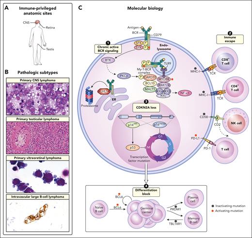 Unifying clinical and biologic features of IP-LBCL and IVLBCL. (A) The involved anatomic sites are commonly restricted to extranodal regions at both diagnosis and upon relapse and include the CNS, eye, and testis. (B) The pathologic subtypes included under the proposed umbrella term IP-LBCL include primary CNS lymphoma, primary testicular lymphoma, and PVRL. IVLBCL is also an extranodal ABC lymphoma that shares features with IP-LBCL but does not arise in an anatomic site that is considered to be immune privileged. Primary CNS lymphoma, original magnification ×1000; primary testicular lymphoma, original magnification ×200; primary vitreoretinal lymphoma, original magnification ×1000; intravascular large B-cell lymphoma, original magnification ×400. (C) The molecular biology of IP-LBCL mostly closely resembles that of an ABC phenotype and the MCD genetic subtype of DLBCL. Four main biologic cornerstones that have been described in IP-LBCL include (1) activating mutations of MYD88 (L265P) and CD79B that form the MYD88-TLR9-BCR (My-T-BCR) complex and promote chronic active BCR signaling; (2) inactivating mutations of class 1 and 2 HLA expression as well as CD58, which promote immune escape; (3) loss of CDKN2A, which promotes unregulated cell cycle activation; and (4) inactivating mutations in transcription factors such as PRDM1 and TBL1XR1, that promote ongoing proliferation.