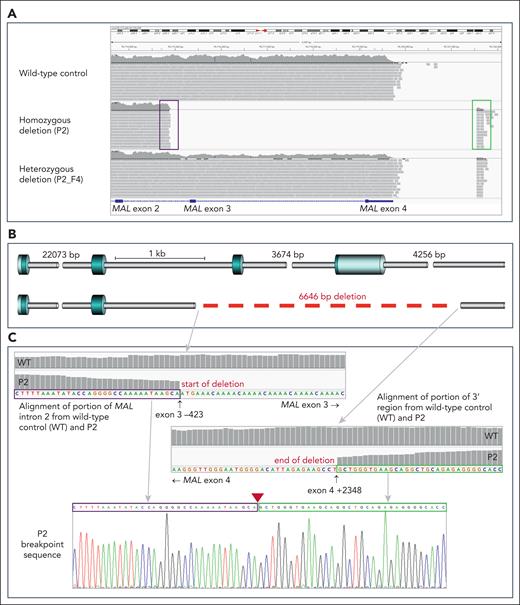 All individuals with inherited AnWj-negative phenotype are homozygous for the same deletion in MAL, encompassing exons 3 and 4. (A) Portion of chromosome 2 sequence, spanning MAL exons 2 to 4, from next-generation sequencing (NGS) targeted–panel sequencing of 3 representative individuals. Wild-type sequence is shown in the upper panel, whereas individual P2 (middle) shows no sequencing reads mapping to exons 3 and 4, with reads spanning the deleted area mapping to intron 2 (boxed in purple) and in the region downstream from exon 4 (boxed in green). The bottom panel shows a deletion heterozygote (P2_F4), with only ∼50% of expected reads mapping to MAL exons 3 and 4, and the end of sequencing reads spanning the deleted area is clearly visible, mapping in the same region as with the homozygous deletion sample above. (B) Gene schematic showing deletion break points. Wild-type MAL (top) consists of 4 coding exons (blue cylinders), whereas the AnWj-negative individuals lack exons 3 and 4 and parts of the adjacent introns (gray cylinders). Deletion (6646 bp) represented by dashed red line. (C) Details of portions of MAL intron 2 (upper left) and 3' region downstream from MAL (lower right) sequence alignment in representative AnWj-negative individual (P2) compared with wild-type control. Sanger sequencing of P2 across the deletion break points is shown in bottom panel; sequence boxed in purple derives from intron 2, whereas sequence boxed in green derives from the 3' region downstream from exon 4. Position of deletion is indicated by red triangle. Break points confirmed by Sanger and/or NGS sequencing to be identical in all AnWj-negative samples (Table 1).