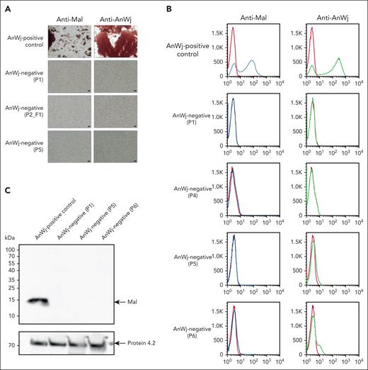 Anti-Mal binds AnWj-positive red cells, but not AnWj-negative cells. (A) Red cells sequentially incubated with either mouse polyclonal anti-Mal (ab167376, Abcam; 1 in 10) or mouse monoclonal anti-AnWj (H86; 1 in 5) followed by goat anti-mouse immunoglobulin G show agglutination in AnWj-positive red cells (top row) but not in AnWj-negative red cells (lower 3 rows). Two representative examples of inherited AnWj-negative phenotype (P1 and P2_F1), both carrying homozygous MAL deletions, and 1 example of suspected AnWj antigen suppression, without MAL mutation (P5) cells, are shown. Negative (secondary antibody only) and positive (anti-GPA; BRIC256) controls were included (data not shown). Scale bars are 40 μm. Cells were imaged using a Leica DM750 microscope (Leica Microsystems) at 100× magnification and imaged using a Pixera Penguin 600CL camera (Digital Imaging Systems). (B) Flow cytometry with anti-Mal (ab167376) and anti-AnWj (H86) on control RBC (top row) and 4 representative examples of AnWj-negative cells, 2 with MAL deletion (P1 and P4), and 2 lacking the MAL deletion (P5 and P6). No detectable expression of Mal or AnWj is observed in any AnWj-negative samples. (C) Red cell membranes prepared from 1 AnWj-positive control and 3 AnWj-negative samples (P1, inherited; P5 and P6, suppression) were immunoblotted using mouse monoclonal anti-Mal antibody E1 (sc-390687; Santa Cruz). A band consistent with full-size Mal (15 kDa) was present in the control sample and absent in all AnWj-negative samples tested. The anti-protein 4.2 (BRIC273) control demonstrates consistent protein loading. A further 2 AnWj-negative samples showed the same results (supplemental Figure 1A). Multiple commercially available anti-Mal antibodies were tested (supplemental Table 3) but only 1 worked in our hands by red cell serology/flow cytometry (ab167376) and 2, E1 (shown here and supplemental Figure 1A) and 6D947 (supplemental Figure 1A-B), by immunoblotting.