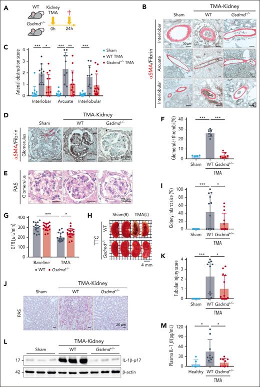 Gsdmd deficiency attenuates focal crystalline TMA, AKI, and ischemic infarction. (A) Illustration of the experimental design. CC (20 mg/kg) was injected into the left renal artery to induce focal TMA in WT and GSDMD knockout (Gsdmd−/−) mice. The mice were euthanized and analyzed after 24 hours. (B) Representative immunohistochemical images of αSMA and fibrin staining of interlobar, arcuate, and interlobular arteries in the kidneys. (C) Quantification of arterial obstruction in sham (n = 13) and TMA kidneys from WT (n = 10) and Gsdmd−/− (n = 13) mice. (D) Representative immunohistochemical images of αSMA and fibrin staining within the glomerular capillaries. (E) Representative images of periodic acid-Schiff (PAS) staining within glomeruli showing characteristics indicative of TMA, including glomerular capillary thrombi and increased capillary wall thickness. (F) Quantification of glomerular fibrin thrombi in sham (n = 4) and TMA kidneys from WT (n = 6) and Gsdmd−/− (n = 6) mice. (G) Glomerular filtration rate (GFR) at baseline and 24 hours after focal TMA induction in WT mice (n = 16) and Gsdmd−/− mice (n = 18). (H) Representative images of 2,3,5-Triphenyltetrazolium chloride (TTC) staining of TMA (left) and sham (contralateral right) kidneys of WT and Gsdmd−/− mice. Red areas indicate living kidney tissue, whereas white areas indicate infarcted kidney tissue. (I) Quantification of infarct size in sham (n = 25) and TMA kidneys from WT (n = 12) and Gsdmd−/− (n = 13) mice. (J) Representative images of PAS staining in sham and TMA kidneys from WT and Gsdmd−/− mice. (K) Quantification of tubular injury in sham (n = 13) and TMA kidneys from WT (n = 10) and Gsdmd−/− (n = 13) mice. (L) Immunoblot analysis of mature IL-1β (p17) in the kidneys of 3 sets of sham, WT, and Gsdmd−/− mice with focal TMA. β-actin was used as a loading control. (M) Plasma levels of IL-1β in healthy mice (n = 6) and focal TMA mice (WT: n = 9, Gsdmd−/−: n = 9) were quantified using enzyme-linked immunosorbent assay (ELISA). Scale bars: for panels B,D-E,J, 20 μm, and for panel H, 4 mm. The data represent mean ± SD. ∗P < .05, ∗∗P < .01, and ∗∗∗P < .001 using 2-way ANOVA with Bonferroni multiple comparisons test for panels C,G, or 1-way ANOVA with Tukey post hoc test for panels F,I,K,M.