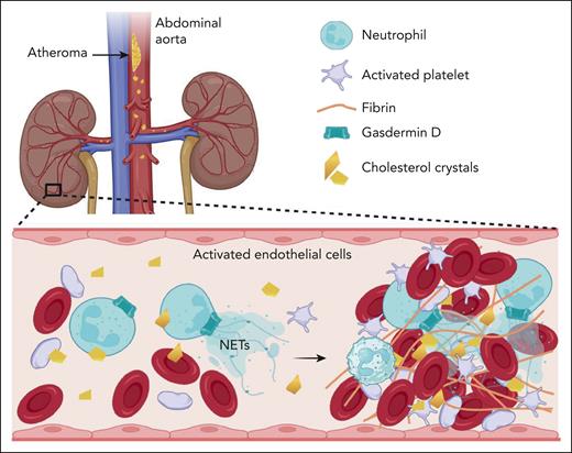 Model depicting cholesterol emboli, originating from the atheromatous plaques of the abdominal aorta, activate gasdermin D on neutrophils, leading to pyroptosis-mediated neutrophil extracellular trap (NET)osis, thromboinflammation, and subsequent obstruction of microcirculation in the kidney. Figure created using bioRender.