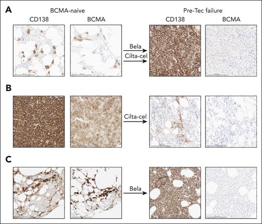 Therapy–triggered loss of plasma cell BCMA expression. Biopsy samples from 3 patients before initial anti-BCMA therapy (left, BCMA-naïve) are shown in contrast to biopsy samples after initial anti-BCMA therapy and prior to teclistamab treatment (right, Pre-Tec failure). (A) Patient 1 following belantamab mafoditin (bela) and cilta-cel treatment. (B) Patient 2 following cilta-cel treatment. (C) Patient 3 following belantamab treatment.
