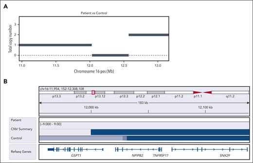 TNFRSF17 deletion after belantamab treatment. (A) CNV analysis of bulk WES data from patient 1 following relapse from belantamab treatment demonstrates loss of both copies of TNFRSF17. This is consistent with the emergence of a plasma cell clone with biallelic loss of TNFRSF17 (supplemental Figure 1) and explains the lack of BCMA expression seen in patient 1. (B) Integrative genomic viewer (IGV) snapshot showing the genomic deletion beginning at ∼12 Mb on chromosome 16 and covering the entire TNFRSF17 locus. CNV, copy number variant.