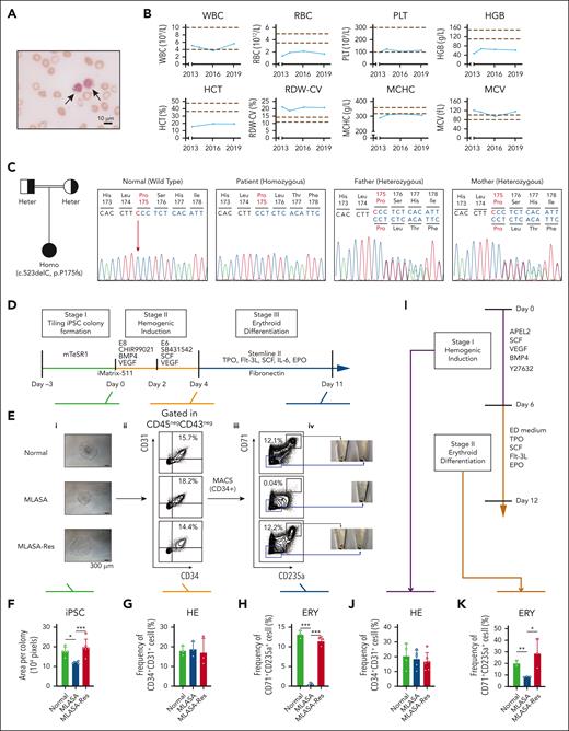 PUS1 p.P175fs mutation leads to abnormal erythroid differentiation. (A) Representative image of BM iron stain of the patient with MLASA. Black arrows indicate ring sideroblasts. (B) Blood routine data of the patient from 2013 to 2019. Red dotted lines define the normal ranges. (C) Pedigree tree of the patient’s family (left panel) and chromatograms of Sanger sequencing results (right panels). The patient has a homozygous PUS1 mutation (c.523delC) is indicated by blackened symbols. Her parents carrying the same but heterozygous mutation are also indicated. The mutant proline at position 175 is marked with red, and the red arrow points to the location of the missing cytosine at position 523. (D) The schematic diagram of 3-stage erythroid differentiation from iPSCs. Green line: stage of tiling iPSC colony formation; orange line: stage of hemogenic induction; and blue line: stage of erythroid differentiation. (E) Analysis of 3-stage erythroid differentiation efficiency at different stages. Representative images of iPSC colonies (i). Flow cytometry analysis of hemogenic endothelium cells (HEs) (ii) and erythroblasts (iii). Cell pellets of CD71+CD235+ cells and CD71–CD235- cells produced by HEs in vitro for 7 days (iv). (F-H) Quantification of the sizes of iPSC colonies (F; normal, n = 5; MLASA, n = 5; MLASA-Res, n = 6), the percentages of HE cells (G; CD34+CD31+, n = 3) and erythroblasts (H; CD71+CD235a+, n = 3). (I) The schematic diagram of iPSCs normoxia strategy 1. Purple line: stage of hemogenic induction; and brown line: stage of erythroid differentiation. (J-K) Quantification of the flow cytometry analysis of HE cells (J; normal, n = 4; MLASA, n = 5; MLASA-Res, n = 6), and erythroblasts (K; normal, n = 2; MLASA, n = 3; MLASA-Res, n = 3) derived from iPSCs under normoxia induction strategy 1. Values in all panels denote mean ± standard deviation (SD; ∗P < .05; ∗∗P < .01); 1-way analysis of variance (ANOVA). ERY, erythropoiesis; MCHC, mean corpuscular hemoglobin concentration; MCV, mean corpuscular volume; PLT, platelet; RDW-CV, RBC volume distribution width-coefficient of variation; WBC, white blood cell.