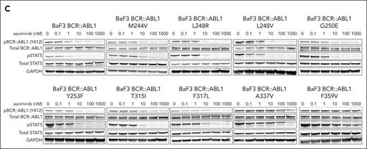 BCR::ABL1 M244V and other N-lobe mutations are associated with resistance to asciminib. (A) Hematologic and molecular parameters of 4 patients with preexisting or rapidly emerging M244V substitutions. Dotted lines represent normal reference range for hematologic parameters. Dose (mg) and duration of TKI therapy is listed below each graph. BCR::ABL1 transcript levels were not assessed for patient 1, as this patient had never had an appreciable molecular response during 10 years of prior TKI therapy. (B) Normalized viability of Ba/F3 cells transduced with BCR::ABL1 isoforms depicted in increasing concentrations of asciminib after 48 hours of treatment. Data represent 3 independent experiments. Error bars represent standard error of the mean. EC50 values are represented in the table. (C) Representatives of 3 immunoblots of lysates of Ba/F3 cells expressing the isoforms listed in increasing concentrations of asciminib. Cells were lysed after 2 hours of asciminib exposure. GAPDH, glyceraldehyde-3-phosphate dehydrogenase; pSTAT5, phosphorylated STAT5.