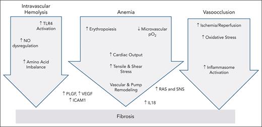 A simple schematic illustrating the redundancy of pathways causally linking the primary red cell defect to cardiac fibrosis. Hemolysis, anemia, and vaso-occlusion represent the proximal stimuli, but so many interrelationships exist across these pathways that connecting arrows were suppressed for clarity. Some mediators clearly lie outside any given pathway, and other connections and mediators remain to be elucidated. Although IL-18 has shown promise as a convergent pathway for fibrosis and arrhythmias in mouse models,3,4 its suitability as a drug target in humans remains an open question. NO, nitric oxide; PLGF, placentally derived growth factor; RAS, renin-angiotensin-aldosterone system; SNS, sympathetic nervous system; VEGF, vascular endothelial growth factor.