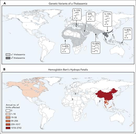 Worldwide distribution of α-thalassemia. Predominant global distribution of α-thalassemia mutations (including α0 deletions) (A) and Hb Bart’s hydrops fetalis (B). It should be noted that, as a result of migration, these genotypes are now widely present in many other areas. Reproduced with permission, with minor modifications, from Piel and Weatherall.1