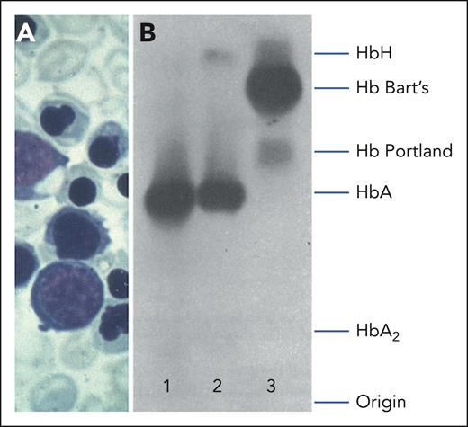 Clinical and hematological features of Hb Bart’s hydrops fetalis. (A) Peripheral blood smear of an infant showing immature red cell precursors, hypochromic microcytosis, and anisopoikilocytosis. (B) Starch gel electrophoresis of hemolysates from a normal adult (lane 1); an individual with HbH disease (lane 2), and the cord blood of an infant with Hb Bart's hydrops fetalis (lane 3). Reproduced with permission, with minor modifications from Higgs13 and Pressley et al.14