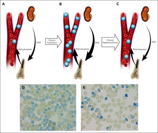 Schematic representation of different transfusion strategies in ATM underlying its unique pathophysiology. In patients who received conventional transfusion (A), over time, preserved reticulocytosis will lead to an increased proportion of endogenous erythrocytes that exclusively contain nonfunctional HbH (HbH cells; shown as “blue golf ball” cells) (B). In this setting, despite a stable pretransfusion Hb, the proportion of functional Hb is decreased. The tissue hypoxia will subsequently lead to further increase of erythropoietin (EPO) and expansion of bone marrow erythron. Furthermore, the increased circulating HbH cells will lead to increased extravascular and intravascular hemolysis. (C) In contrast, a more aggressive transfusion (hypertransfusion) aimed at reduction of HbH and increase in functional Hb (non-HbH) will result in improved tissue oxygenation, reduction in EPO, reduced erythropoiesis, and diminished hemolysis. (D- E) Peripheral blood smear supravital stain of an adolescent with ATM, before (HbH, 64%) and after 4 cycles of exchange transfusion and subsequent hypertransfusion (HbH, 14%), respectively. Note the significant reduction in the HbH cells in peripheral blood smear, leading to improved functional Hb.