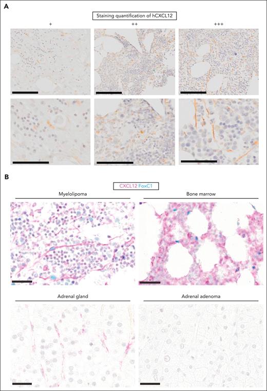 CXCL12+ cells of stromal morphology are present in human myelolipoma and coexpress FOXC1. (A) Representative images of CXCL12 standard IHC staining (brown) of human myelolipoma samples corresponding, from left to right, to patients I, C, and D (see Table 1 for details). Scale bars correspond to 200 μm and 100 μm in the top and bottom panels, respectively. (B) Double chromogenic immunohistochemical stain for CXCL12 (pink) and FOXC1 (light blue) in human myelolipoma, BM, healthy adrenal gland, and adrenal adenoma. Scale bar represents 30 μm at all instances.