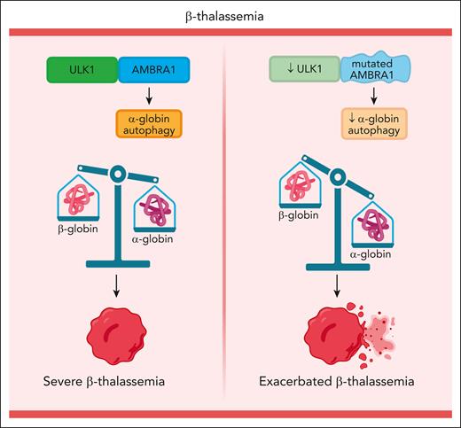 In β-thalassemia, during terminal erythroid maturation, β-globin (HBB) gene mutations cause a buildup of free α-globin, which forms toxic intracellular precipitates, causing ineffective erythropoiesis and hemolysis. AMBRA1 missense mutations reduce ULK1-mediated autophagy of free α-globin and exacerbate β-thalassemia. Figure created with BioRender.com.