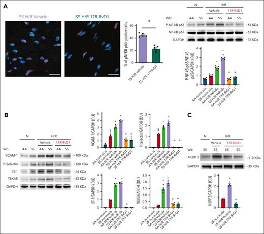 17R-RvD1 prevents the activation of NF-κB–dependent pathways and reduces NLRP3 inflammasome. (A) Activated phosphorylated NF-κB p65 (p-NF-κB p65) in heart cells identified with immunofluorescence staining (size scale bar, 20 μm) in SS mice exposed to H/R stress and treated with either vehicle or 17R-RvD1 (left). Data are presented as mean ± SEM (n = 5). °P < .05 (compared with vehicle-treated H/R SS mice by t test). Quantification of total NF-κB in heart cells is shown in supplemental Figure 8B. Immunoblot analysis (right), using specific antibodies against p-NF-κB p65 and NF-κB p65, of heart from AA and SS mice under normoxia and treated with vehicle or 17R-RvD1 (100 ng) and exposed to H/R: hypoxia (8% oxygen; 10 hours), followed by reoxygenation (21% oxygen; 3 hours). A total of 75 μg/μL of protein loaded on an 8% T, 2.5% C polyacrylamide gel. Glyceraldehyde 3-phosphate dehydrogenase (GAPDH) serves as protein loading control. One representative gel from 4 with similar results is shown. Densitometric analysis of immunoblots is shown (right). Data are presented as means ± SEM (n = 4). ∗P < .05 (compared with normoxia); °P < .05 (compared with vehicle-treated mice by 1-way ANOVA). (B) Immunoblot analysis, using specific antibodies against P-selectin, ET-1, and thromboxane synthase (TBXS), in the hearts of AA and SS mice treated. A total of 75 μg/μL of protein loaded on an 11% T, 2.5% C polyacrylamide gel. GAPDH serves as protein loading control. One representative gel from 4 with similar results is shown. Densitometric analysis of immunoblots is shown (right). Data are presented as means ± SEM (n = 4). ∗P < .05 (compared with normoxia); §P < .05 (compared with AA normoxia); °P < .05 (compared with vehicle-treated mice by 1-way ANOVA). (C) Immunoblot analysis, using specific antibodies against NLRP3, in the hearts of AA and SS mice, treated similar to panel B. A total of 75 μg/μL of protein loaded on an 8% T, 2.5% C polyacrylamide gel. GAPDH serves as protein loading control. One representative gel from 4 with similar results is shown. Densitometric analysis of immunoblots is shown (lower). Data are presented as means ± SEM (n = 4). ∗P < .05 (compared with normoxia); °P < .05 (compared with vehicle-treated mice). Wb, Western blot.