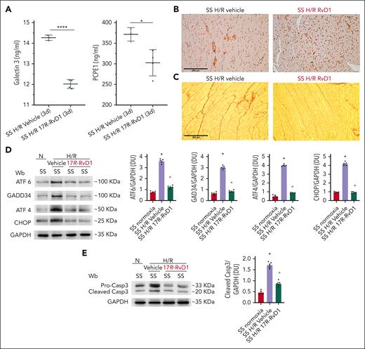 In sickle cell mice, 17R-RvD1 reduces proangiogenic signaling, prevents H/R-induced ER stress, and protects against proapoptotic H/R-induced signature. (A) Serum Gal-3 (left) and procollagen C-proteinase enhancer-1 (PCPE1) in SS mice treated with either vehicle or 17R-RvD1 at 3 days after H/R stress. Data are presented as mean ± SEM (n = 3-4). ∗P < .05; ∗∗∗P < .005 (by unpaired t test, with Welch correction). a-SMA (B) and Picrosirius Red (C) staining in cardiac slices from SS mice treated with either vehicle or 17R-RvD1 at 3 days after H/R stress. (D) Immunoblot analysis using specific antibodies against ATF6, GADD34, ATF4, and CHOP in the hearts of AA and SS mice under normoxia, treated with vehicle or 17R-RvD1 (100 ng), and exposed to H/R: hypoxia (8% oxygen; 10 hours), followed by reoxygenation (21% oxygen; 3 hours). One representative gel from 4 gels with similar results is shown; 75 μg/μL of protein loaded on an 11% T, 2.5% C polyacrylamide gel. Glyceraldehyde 3-phosphate dehydrogenase (GAPDH) serves as protein loading control. Densitometric analysis of immunoblots is shown (right). Data are presented as means ± SEM (n = 4). ∗P < .05 (compared with normoxia); °P < .05 (compared with vehicle-treated mice by 1-way ANOVA). (E) Immunoblot analysis using specific antibodies against caspase-3 in the hearts of AA and SS mice under normoxia, treated with vehicle or 17R-RvD1 (100 ng), and exposed to H/R: hypoxia (8% oxygen; 10 hours), followed by reoxygenation (21% oxygen; 3 hours). One representative gel from 4 gels with similar results is shown; 75 μg/μL of protein loaded on an 11% T, 2.5% C polyacrylamide gel. GAPDH serves as protein loading control. Densitometric analysis of immunoblots is shown (lower). Data are presented as means ± SEM (n = 4). ∗P < .05 (compared with normoxia). °P < .05 (compared with vehicle-treated mice by 1-way ANOVA). Wb, Western blot.