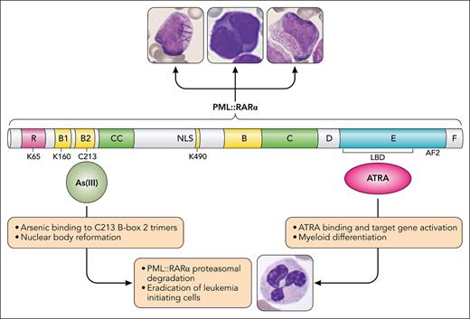 The PML::RARα fusion protein drives all the morphological variants of t(15;17) APL by disrupting nuclear bodies and blocking myeloid cell differentiation at the promyelocyte stage. Arsenic and ATRA target the PML and RARα components of the fusion protein, respectively. ATRA binds to the ligand binding domain (LBD) of RARα and induces conformational change, releasing corepressors and activating transcription of target genes involved in myeloid differentiation. As(III), the active component of arsenic trioxide, binds a pocket formed by C213 residues in PML B-box 2 trimers and induces a cascade of events resulting in nuclear body reformation, PML and PML::RARα sumoylation, polyubiquitination, and proteasomal degradation. Cellular images courtesy of the ASH Image Bank (image IDs #00005911, #00063635, and #00003608). Professional illustration by Patrick Lane, ScEYEnce Studios.