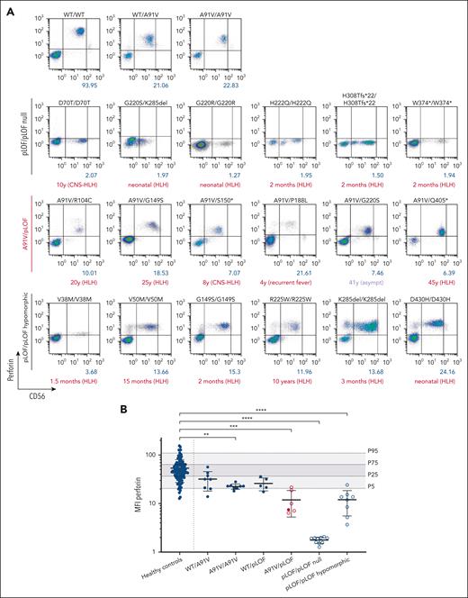 Intracellular perforin expression in patient-derived A91V/pLOF CD3−CD56+ NK cells. (A) Flow cytometry dot plots of perforin expression levels in CD3−CD56+ NK cells with different PRF1 genotypes. First row: PRF1 WT, A91V/WT, and A91V/A91V carriers. Second row: homozygous PRF1 “null” variants (pLOF/pLOF null). Third row: PRF1 A91V/pLOF genotypes. Fourth row: homozygous PRF1 hypomorphic variants (pLOF/pLOF hypomorphic). Perforin mean fluorescence intensity (MFI) is shown in blue, age of onset of clinical manifestations and phenotype is shown in red below the panels. (B) Perforin MFI for different PRF1 genotypes. Percentile 5, 25, 75, and 95 of perforin expression in 120 nonsequenced healthy controls are indicated by gray areas. Filled circles, asymptomatic individuals; empty circles, symptomatic individuals. Ordinary 1-way analysis of variance of perforin MFI between healthy controls and PRF1 variant carriers (∗∗P < .01; ∗∗∗P < .001; ∗∗∗∗P < .0001).