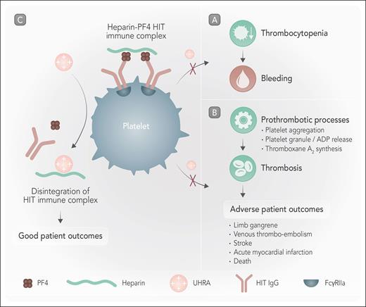 Immune complex disintegration leads to good patient outcomes. Heparin-PF4 immune complex binds to FcγRIIA receptors on platelets. (A) HIT immune complex binding to platelets leads to thrombocytopenia and bleeding. (B) Cross-linking FcγRIIA receptors by platelet-bound immune complex leads to platelet activation, aggregation, granule/adenosine 5′-diphosphate (ADP) release, and thromboxane A2 synthesis. These and other prothrombotic processes (including neutrophil activation and NETosis) induce thrombosis, which results in adverse patient outcomes. (C) Immune complex dissociation by cationic UHRA inhibits A and B and results in good patient outcomes. Professional illustration by Somersault18:24.
