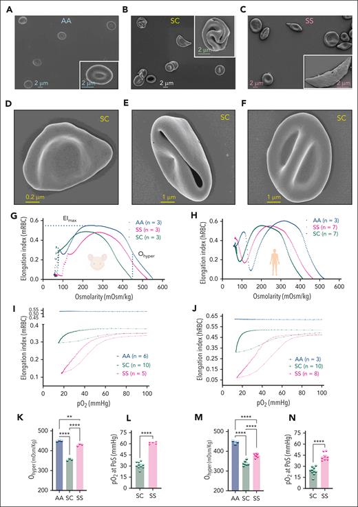 Morphology, hydration, and sickling kinetics of HbSC RBCs. (A-C) SEM images of AA, SC, and SS erythrocytes. Insets show an enlarged version of a classical and representative RBCs in each group. (D-F) Representative SC erythrocytes. Specimens were imaged using a Zeiss FE-SEM (Supra 35 VP) at 2 to 5 keV with a working distance of 3 to 5 mm using the Inlens detector. The magnification scale is shown within the micrographs and insets. (G) Osmoscan curves for mRBCs, showing the RBC deformability under varying osmolarities. The EI is plotted against osmolarity for HbAA, HbSS, and HbSC RBCs, 3 samples per group. The curves illustrate the deformability of RBCs, with maximal EI occurring at iso-osmolar conditions and shifting left for dehydrated cells (xerocytosis). (H) Osmoscan curves for hRBCs under varying osmolar conditions. (I) Oxyscan curves of mRBCs in HbAA (n = 6), HbSC (n = 10), and HbSS (n = 5). (J) Oxyscan curves of hRBCs in HbAA (n = 3), HbSC (n = 10), and HbSS (n = 8). (K) Ohyper in mRBCs indicates the osmolarity in the hyperosmolar region at which the RBCs achieve half of their maximal elongation. (L) The PoS, defined as the pO2 at which a >5% decrease in EI is observed during deoxygenation, indicating the onset of sickling in mRBCs. (M) Ohyper in hRBCs. (N) PoS in hRBCs. For panels K through N: each symbol represents an individual sample, and bars represent mean ± standard error of the mean. Statistics were performed using ANOVA. ∗∗P < .01; ∗∗∗∗P < .00001. mOsm, milliosmoles.