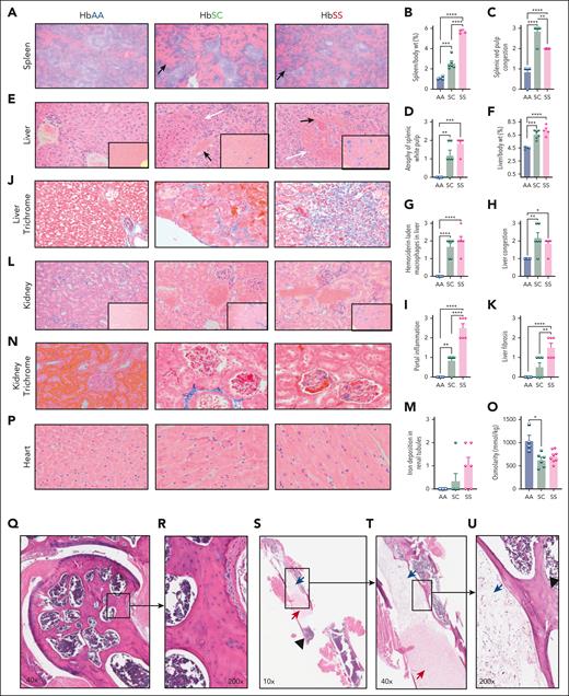 Histopathological evaluation of multiple organs of 7-month-old HbSC mice. (A) Representative histological spleen sections stained with hematoxylin and eosin (H&E) of HbAA (right), HbSC (middle), and HbSS (left). Black arrows point to expanded red pulps with congested sinusoids, original magnification ×100. (B) Spleen-to-body-weight ratio. Scoring of splenic red pulp congestion (C) and atrophy of white pulps based on pathology scoring of the spleen (D; supplemental Table 1). (E) Representative H&E pictures of liver sections illustrating congestion (black arrows), and areas of infarcts (blue arrows), original magnification ×200. Insets showing Prussian blue staining for each group. (F) Liver-to-body-weight ratio. Scoring of hemosiderin (G), the liver congestion (H), and portal inflammation (I) based on pathology scoring of the liver (supplemental Table 2). Representative Masson trichrome staining of liver sections (original magnification ×400; J) and liver fibrosis scoring (K), see more details in (supplemental Table 2). (L) Representative H&E pictures of kidney sections with insets showing Prussian blue staining for each group (original magnification ×200). (M) Iron deposition in the renal tubes based on pathology scoring of the kidney (supplemental Table 3). (N) Representative Masson trichrome staining of kidney sections (original magnification ×400). (O) Urine osmolarity, 6 hours; mice were 6 months old in this test. (P) Representative H&E pictures of heart sections (original magnification ×400), with insets showing original magnification ×20. Statistics were performed using ANOVA. ∗P < .05; ∗∗P < .01; ∗∗∗P < .001; ∗∗∗∗P < .00001. (Q) Representative H&E-stained bone and femoral sections of 1-year-old HbAA (n = 3), HbSC (n = 3), and HbSS (n = 5) with normal bone architecture and hematopoietic marrow (R) with intact osteocytes occupying the lacunae. (S-U) One abnormal mouse from HbSS group. The SCD mouse exhibits features of bone pathology, including coagulative necrosis of the bone marrow and local bone infarction, characterized by empty osteocyte lacunae (highlighted inset). wt, weight.