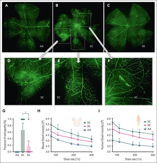 Sickle retinopathy in HbSC mice. Retinal vasculature was visualized after IV fluorescein isothiocyanate-dextran injections in 7-month-old AA, SC, and SS mice, and images were captured after dissection of the retina by a Nikon C2 confocal laser scanning microscope. Representative images of the retina in AA (A), SC (B), and SS (C) are shown. (D-F) Magnifications of the boxed areas from panel B (HbSC retina) show the neovascularization and abnormal blood vessel growth, “comma”-shaped vessels, and vascular leakage. (G) Percentage of mice with retinopathy (n = 6 in the SC and SS groups, n = 3 in the AA group of mice). No AA mice had retinopathy. Statistics were performed using ANOVA. ∗P < .05. Whole-blood viscosity in mice (H) and human samples (I) is shown at 5 different shear rates. Each line represents the mean + standard error of the mean of 3 to 6 mice or human blood samples per group. cP, centipoise.