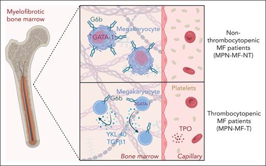 G6b expression and YKL-40 secretion correlate with platelet counts in patients with MF. Thrombocytopenia is a common symptom of MF and can be exacerbated upon treatment with JAK2 inhibitors. In nonthrombocytopenic patients with MF, MKs express high levels of the MK and platelet inhibitory receptor G6b, which correlates to high GATA-1 levels and sufficient cytoplasmic maturation. Thrombocytopenia in MF, however, is associated with impaired G6b expression, low GATA-1 levels and increased inflammatory cytokine secretion. Autocrine and paracrine signaling of both the secreted glycoprotein YKL-40 and the profibrotic TGFβ1 further attenuate MK maturation. The figure was created with BioRender.com. Roweth H. (2025) https://BioRender.com/up5g4as.