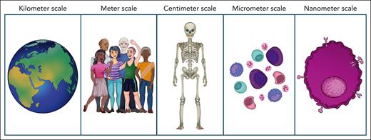 Unraveling myeloma heterogeneity: from nanometers to kilometers. Spatial transcriptomics is a powerful and promising technique that enables the study of myeloma and its microenvironment at the micrometer scale. However, a comprehensive understanding of myeloma biology requires consideration of additional layers of complexity. These include geographical differences in disease incidence (kilometer scale), interpatient heterogeneity such as molecular subgroups (meter scale), distinct growth patterns and local disease distribution within and beyond the skeletal system, including diffuse infiltration, as well as extra- and paramedullary manifestations (centimeter scale), and variation in surface molecule expression among individual tumor cells (nanometer scale). The figure was prepared by Emilia Stanojkovska.