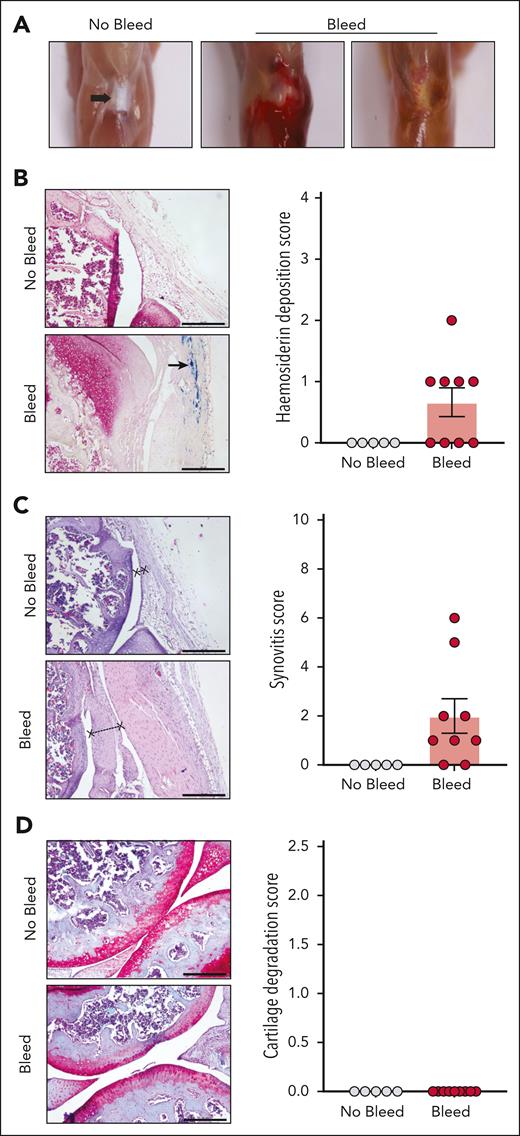 F8em1−/− mice spontaneously develop HA. (A) Visual representation of hind legs from F8em1−/− mouse without bleed (no bleed) and with spontaneous acute (middle) and chronic bleed (right). Arrow shows knee patella. (B-D) Histological analysis of mouse hind knee joints of F8em1−/− mice without or with joint bleeds. Knee joints were stained with Prussian blue staining (B), showing hemosiderin deposition (indicated by arrow) and scoring. (C) Hematoxylin and eosin (H&E) staining for synovial hyperplasia and inflammation (synovium indicated by x----x) and synovitis scores; (D) Safranin O staining for cartilage (red) and degradation scoring. The scale bars represent 500 μm (Prussian blue and H&E) and 200 μm (safranin O). Data are from 5 to 9 mice per group.
