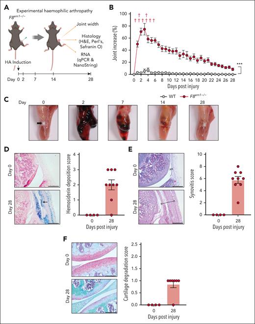 Experimental HA in F8em1−/− mice after a needle knee injury. (A) Protocol for HA. Intra-articular bleeding was induced in male F8em1−/− mice and WT control mice via subpatella needle injury of the right knee joint (see the supplemental Methods for details). (B) Relative increase in right knee joint diameter (percentage) after needle injury in the F8em1−/− compared with WT control mice (n = 9-14 mice per group). Red crosses indicate deaths of F8em1−/− mice. Data are represented as mean with SEM from 3 separate experiments. (C) Representative images of bleeding in the knee joint of F8em1−/− mouse before (day 0), and 2, 7, 14, and 28 days after needle injury. Histology of F8em1−/− mouse knee joints and scoring on day 0 and 28 days after needle injury, and stained with Prussian blue for hemosiderin (arrow) and deposition scores (D); H&E for synovial hyperplasia and inflammation (indicated x----x) and synovitis scores (E); and safranin O for cartilage (red) and degradation scores (F). Data are presented as mean ± SEM from 4 to 9 mice per group. The scale bars represent 500 μm (Prussian blue and H&E) and 200 μm (safranin O). qPCR, quantitative polymerase chain reaction.