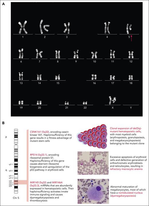 Interstitial deletion of the long arm of 1 chromosome 5 and molecular pathogenesis of the MDS-del(5q). (A) The karyogram (R-banding) of a patient with MDS-del(5q): the red arrow indicates the chromosome 5 with an interstitial deletion of the q arm involving bands q31 to q34. (B) The role of haploinsufficiency of multiple genes, located in the common deletion region 5q32-5q33, in the pathophysiology of MDS-del(5q). The karyogram is from the UZ Leuven (Belgium), the institution in which Herman Van den Berghe worked for many years. The microphotographs of the peripheral blood and bone marrow are from the Division of Hematology, Fondazione IRCCS Policlinico San Matteo and University of Pavia (Italy).