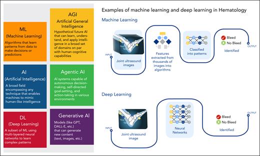 Definitions of AI subtypes and examples of ML and DL applications in hematology. Various definitions of AI subtypes are illustrated and examples of ML and DL techniques in the field of hematology are shown.