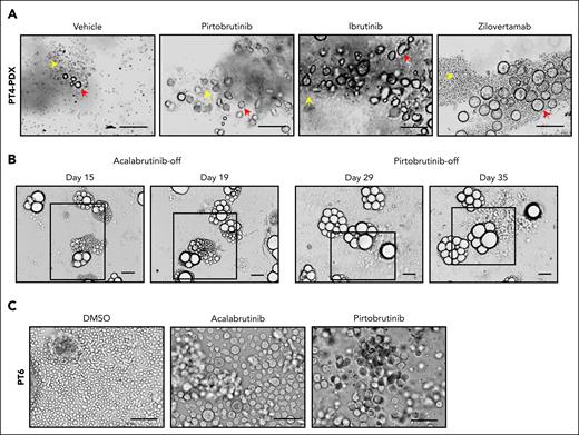 Cell morphology change renders tolerance to therapies in MCL preclinical models. (A) Enlarged tumor cells were detected in PDX samples from patient 4 (PT4) treated with BTKis (pirtobrutinib and IBN), or anti–ROR1 (receptor tyrosine kinase–like orphan receptor 1) monoclonal antibody zilovertamab. Yellow arrows, regular-sized tumor cells; red arrows, enlarged tumor cells. Scale bar, 100 μm. (B) The enlarged cells from the PDX tumor (PT4) were cultured as PDOs treated with acalabrutinib (10 μM) or pirtobrutinib (10 μM) for 2 weeks. They reproliferated as regular-sized tumor cells upon drug removal. Representative brightfield images are shown at different time points. Active proliferating/expanding cells are highlighted by squares. Scale bar, 100 μm. (C) Representative images of enlarged cells generated in the ex vivo PDO model using apheresis from PT6. The PDOs were treated with acalabrutinib and pirtobrutinib at 10 μM for over 2 weeks. Scale bar, 100 μm. DMSO, dimethyl sulfoxide.