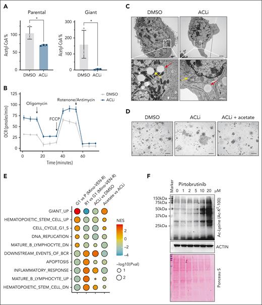 ACL activity determines the states of giant cells. (A) Acetyl-CoA analysis in parental and giant cells treated with or without ACLi (BMS303141) at 10 μM for 48 hours. ∗P < .05. (B) OCR in Mino-VEN-R giant cells treated with or without ACLi (10 μM for 16 hours). (C) Representative transmission electron microscopy imaging of giant cells treated with or without ACLi (10 μM for 48 hours) and acetate supplement (20 mM for 48 hours). Lipid droplet (red arrow) and mitochondria (yellow arrow). Scale bar, 200 nm. (D) Representative imaging showing giant cells reproliferated after drug removal treated with ACLi (10 μM; 9 days); acetate supplement (20 mM) prevented giant cells from reproliferating. Scale bar, 100 μm. (E) GSEA of pathways in P, G1, R1, and G1 treated with ACLi, and G1 treated with ACLi (10 μM) with acetate supplement (20 mM for 48 hours). (F) Western blots showing globally increased acetylation of nonhistone proteins in giant cells. Ponceau S staining shows total protein levels. NES, normalized enrichment score; Pval, P value.