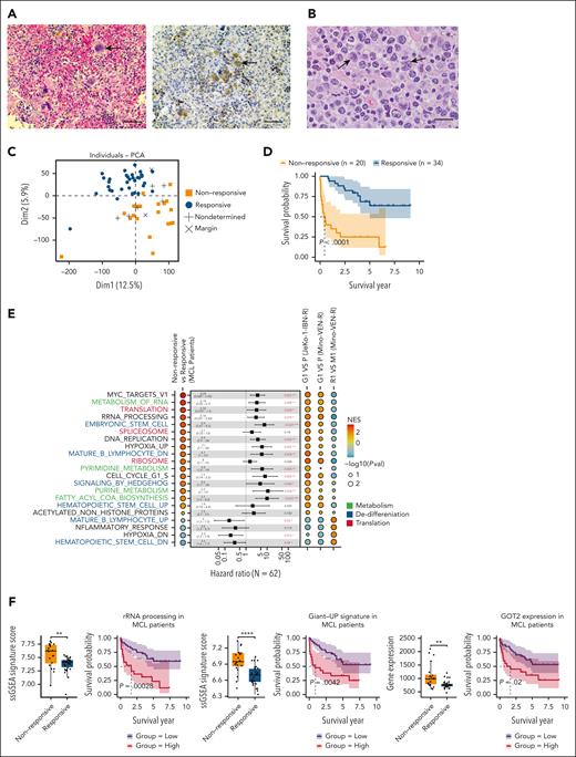 The dynamic presence of DTP cells traversing giant cell state in patients with therapy-resistant MCL. (A) Representative H&E imaging and immunohistochemistry staining of giant cells (arrowed) from the PDX sample with resistance to both anti-CD19 CAR T-cell therapy and PBN showing increased GOT2 level. Scale bar, 50 μm. (B) Representative image showing MCL with pleomorphic morphology in patient after IBN treatment. Enlarged lymphoma cells (predominantly >10 micron in nuclear diameter) were observed to have highly irregular nuclear contours, partially open chromatin, occasional distinct nucleolus, and moderate amount of cytoplasm (arrowed). H&E, ×1000 with oil. Scale bar, 20 μm. (C) PCA showing responses to systemic therapies in patients with MCL. (D) Kaplan-Meier analysis showing survival probability of patients with MCL (responsive vs nonresponsive). (E) GSEA-identified signaling pathways regulated in nonresponsive patients and the Giant cell model. Listed pathways featured in Giant cells are ranked by a NES and colored by pathway types; Cox proportional hazards univariate analysis identified enriched pathways in nonresponsive patients with MCL. False discovery rate q values labeled as indicated. Functional categories are labeled as indicated colors. (F) ssGSEA scores of rRNA processing, Giant_UP gene signatures, and Got2 expression in patients with MCL. Kaplan-Meier survival curves using the rRNA processing, Giant_UP signature scores, and Got2 expression (responsive vs nonresponsive to therapies), with log-rank P = .00028, P = .0042, and P = .02, respectively. ∗∗P < .01; ∗∗∗∗P < .0001. NES, normalized enrichment score; PCA, principal component analysis; Pval, P value; ssGSEA, single sample gene set enrichment analysis.
