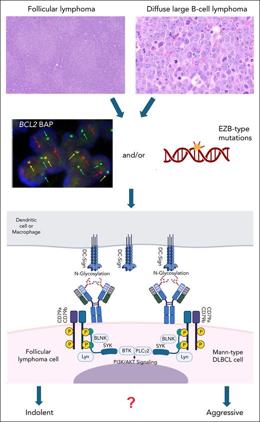 Schematic representation of the role of N-glycosylation in the CDR of the immunoglobulin heavy chain in FL and Mann-type DLBCL. Of note, immunoglobulin light chain CDRs can also be glycosylated in these lymphomas. Mann-type DLBCL (upper right) shares the presence of a BCL2 translocation and/or an EZB-type mutational profile (middle panel) with conventional FL (upper left). Oligomannoses in the CDR of the surface immunoglobulin as part of the BCR bind to DC-SIGN expressed by macrophages or dendritic cells. This results in continuous BCR signaling via CD79a/b with activation of the downstream PI3K/AKT pathway. The difference between the generally indolent behavior of FL and Mann-type DLBCL, especially in comparison with other DLBCL of GCB type, warrants further studies. The figure was created, in part, with BioRender.com. Montes I. (2025) https://BioRender.com/r2fnrs7.