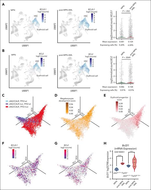 Molecular and functional analysis of LSCs in patients with post-MPN AML. (A) Latent semantic index projection of 4020 cells from 9 patients with MPN and 8507 cells from 14 patients with post-MPN AML, and the expression of BCL2L1 onto the healthy donor (HD) hematopoietic hierarchy atlas shown in supplemental Figure 2E. (B) Latent semantic index projection of the same cell shown in panel A and the expression of BCL2 onto the HD hematopoietic hierarchy atlas shown in supplemental Figure 2E. (C) Three-dimensional diffusion map of 8000 Lin−CD34+ cells from 13 patients with post-MPN AML colored by genotype (left). (D-E) Three-dimensional diffusion map of the same cells from panel C colored by score of megakaryocyte development (D) and erythroid progenitor (E). (F-G) Three-dimensional diffusion map of the same cell shown in panel C colored by BCL2L1 expression (F) and BCL2 expression (G). (H) The expression of BCL2L1 in the leukemic MEPs (Jak2V617F/+Trp53–/– and Jak2V617F/+Trp53R172H/–) compared with MEP derived from mice at the chronic MPN stage. ∗∗∗∗P < .0001; ∗∗∗P < .001. DC, diffusion component; UMAP, uniform manifold approximation and projection.