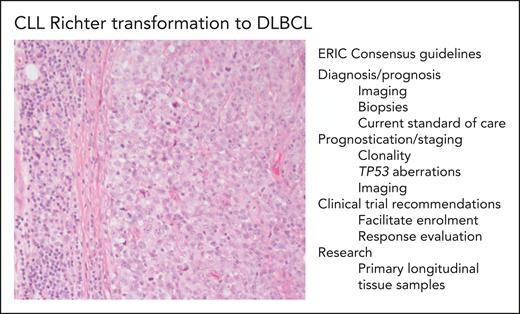 CLL Richter transformation to DLBCL and ERIC consensus guidelines. The photomicrograph (original magnification ×200; hematoxylin and eosin stain) depicts an area of SLL/CLL to the left and an infiltrate of large transformed cells in sheets, which corresponds to Richter transformation to DLBCL, in the right part of the photo. Some of the important points from the international consensus recommendations on diagnosis, evaluation, and research of Richter transformation are listed in the figure.