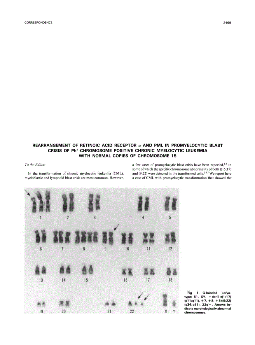 First page of Rearrangement of retinoic acid receptor alpha and PML in promyelocytic blast crisis of Ph1 chromosome positive chronic myelocytic leukemia with normal copies of chromosome 15