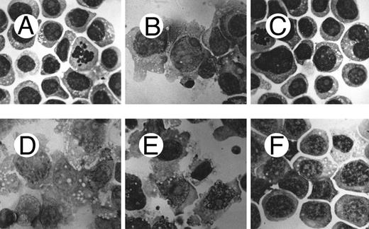Fig. 6. Morphological characteristics of HL60 cells treated with c-fes ODN before and after induction to macrophage differentiation by 48 hours of PMA treatment. (A) ODN untreated HL60 cells; (B) ODN untreated HL60 cells induced to macrophage differentiation with PMA; (C) HL60 cells after 5 days of treatment with hFES-AS-sj1 and 2 ODN; (D) macrophage morphology observed when HL60 cells, pretreated for 5 days with hFES-S-sj1 and 2 ODN, are induced to differentiate with PMA; (E) macrophage morphology observed when HL60 cells, pretreated for 5 days with hFES-IP-sj1 and 2 ODN, are induced to differentiate with PMA; (F ) morphology of HL60 cells pretreated with hFES-AS-sj1 and 2 ODN and PMA induced. This panel is representative of the results obtained by several different experiments. Superimposable results are obtained with both the antisense strategies. Original magnification ×1,000.