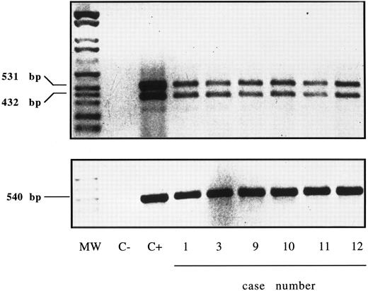 Fig. 10. RT-PCR analysis of the expression of IL-15R α (upper panel) and control β-actin (lower panel) in highly purified GL from 6 LDGL patients. Lane 1, molecular weight marker (Molecular weight VI–digested); lane 2, negative control (sample without cDNA); lane 3, control PBMC stimulated for 12 hours with PHA (5 μg/mL); lanes 4 to 6, 3 CD3+ LDGL cases (cases no. 1, 3, and 9 in Table 1); lanes 7 to 9, 3 CD3− LDGL (cases no. 10 to 12 in Table 1).